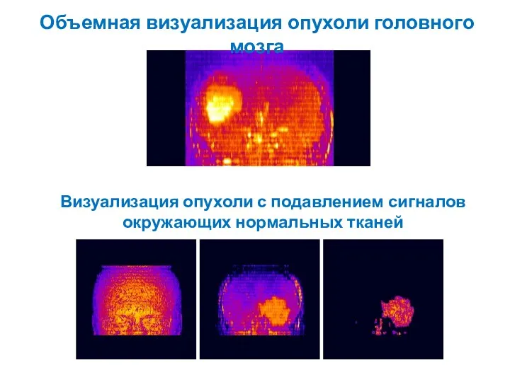 Объемная визуализация опухоли головного мозга Визуализация опухоли с подавлением сигналов окружающих нормальных тканей