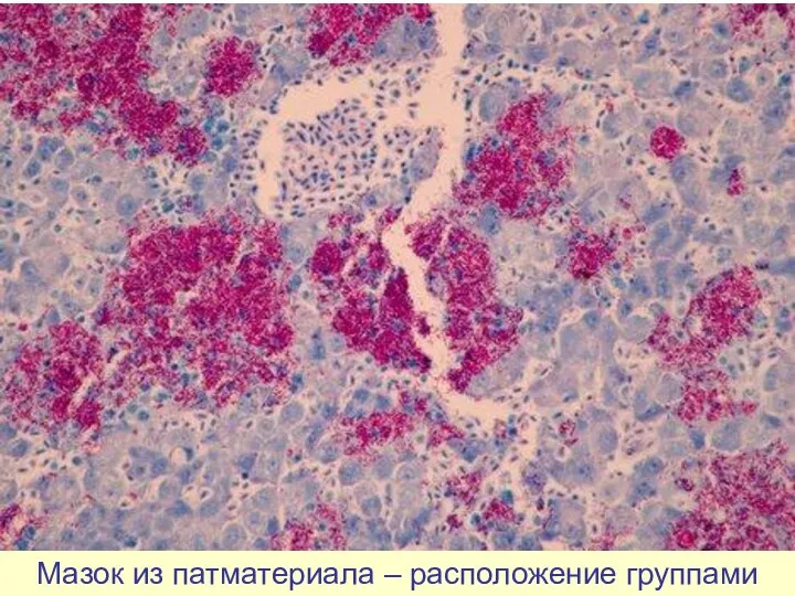 Мазок из патматериала – расположение группами