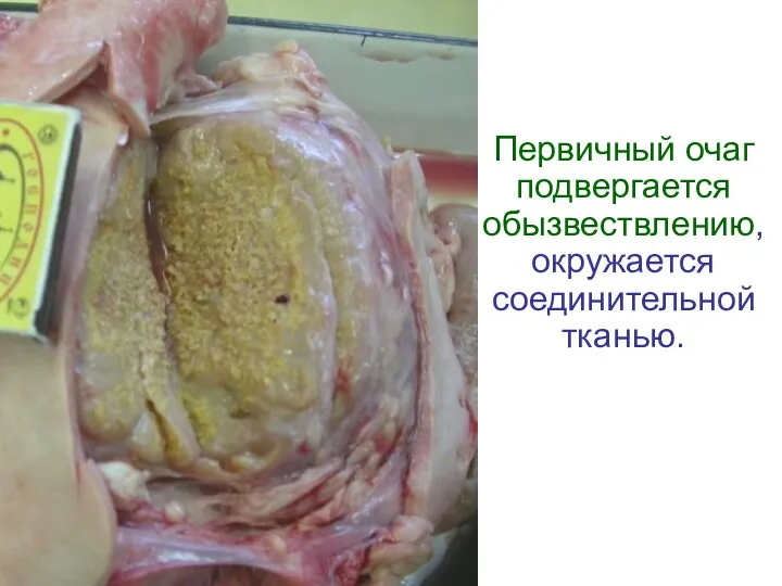 Первичный очаг подвергается обызвествлению, окружается соединительной тканью.