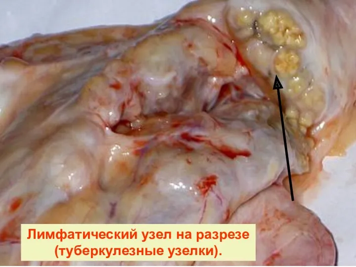 Лимфатический узел на разрезе (туберкулезные узелки).