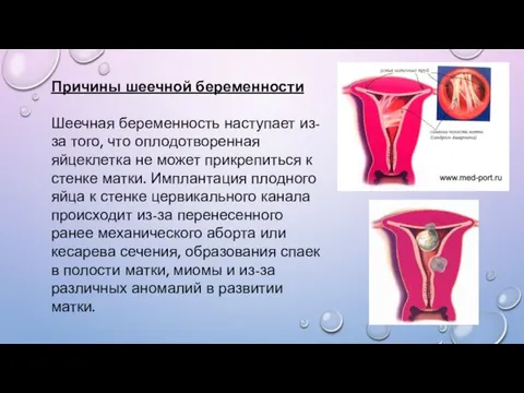 Причины шеечной беременности Шеечная беременность наступает из-за того, что оплодотворенная