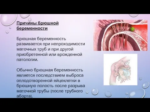 Причины брюшной беременности Брюшная беременность развивается при непроходимости маточных труб