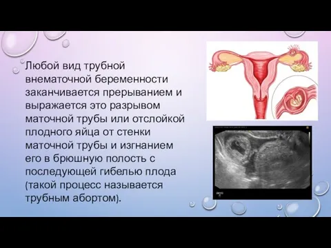 Любой вид трубной внематочной беременности заканчивается прерыванием и выражается это