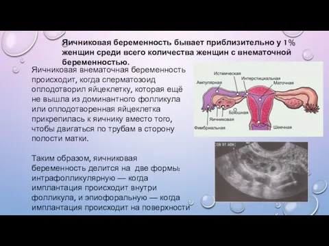 Яичниковая внематочная беременность происходит, когда сперматозоид оплодотворил яйцеклетку, которая ещё
