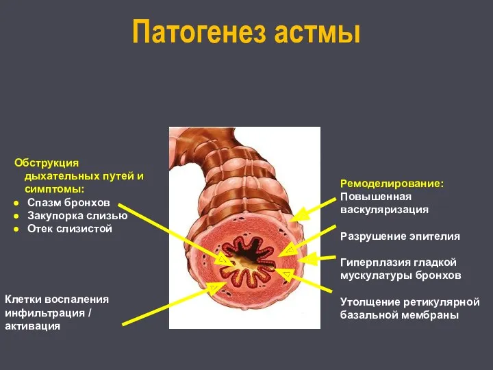 Патогенез астмы Обструкция дыхательных путей и симптомы: Спазм бронхов Закупорка