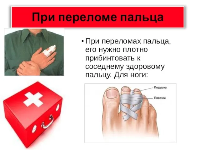 При переломе пальца При переломах пальца, его нужно плотно прибинтовать к соседнему здоровому пальцу. Для ноги: