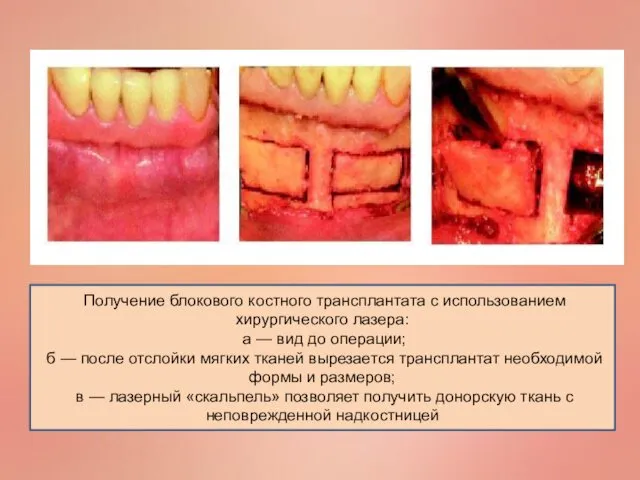 Получение блокового костного трансплантата с использованием хирургического лазера: а —