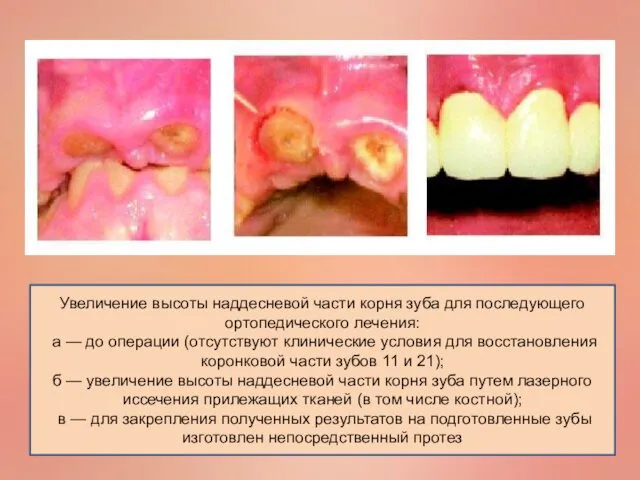 Увеличение высоты наддесневой части корня зуба для последующего ортопедического лечения:
