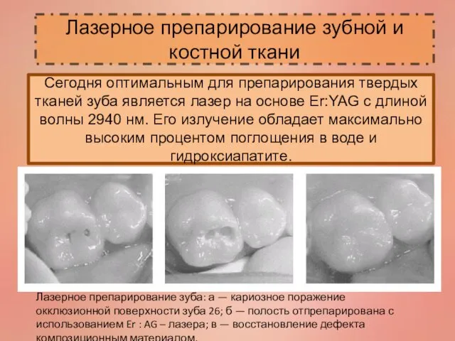 Лазерное препарирование зубной и костной ткани Сегодня оптимальным для препарирования