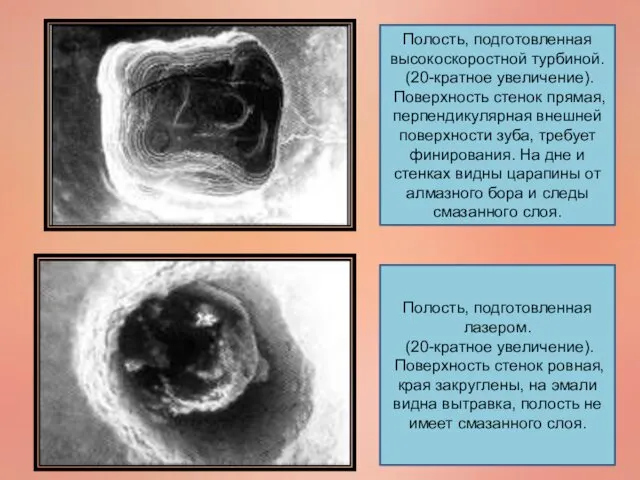 Полость, подготовленная высокоскоростной турбиной. (20-кратное увеличение). Поверхность стенок прямая, перпендикулярная