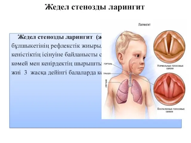 Жедел стенозды ларингит Жедел стенозды ларингит (жалған круп) – көмей