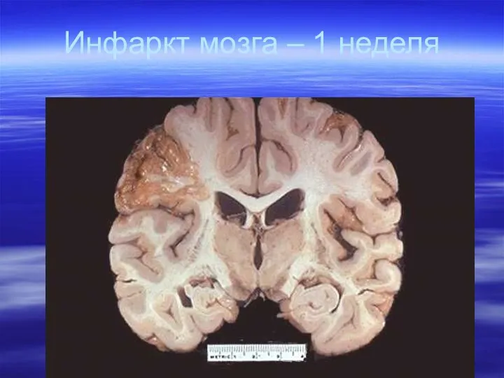 Инфаркт мозга – 1 неделя