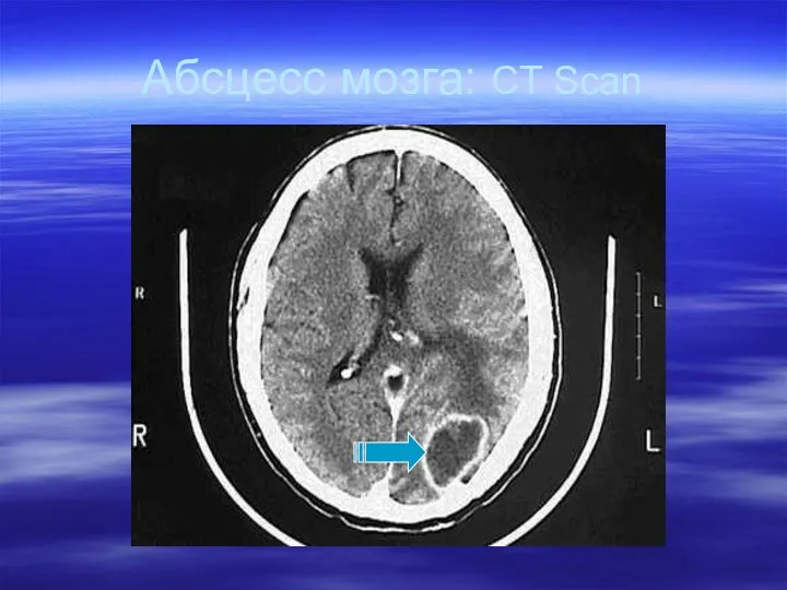 Абсцесс мозга: CT Scan
