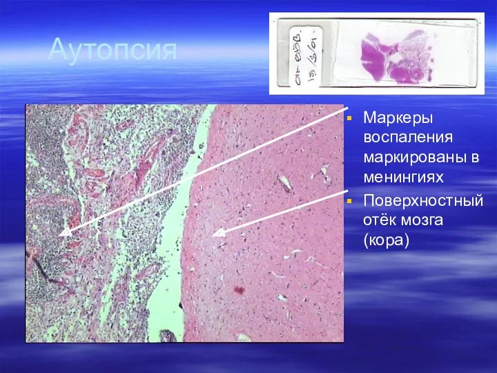 Аутопсия Маркеры воспаления маркированы в менингиях Поверхностный отёк мозга (кора)