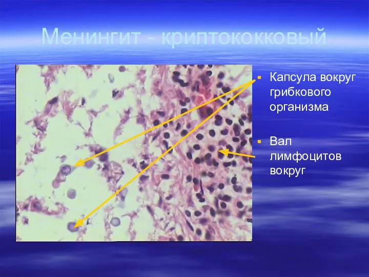 Менингит - криптококковый Капсула вокруг грибкового организма Вал лимфоцитов вокруг