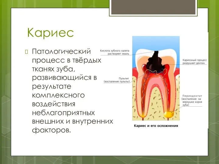 Кариес Патологический процесс в твёрдых тканях зуба, развивающийся в результате комплексного воздействия неблагоприятных