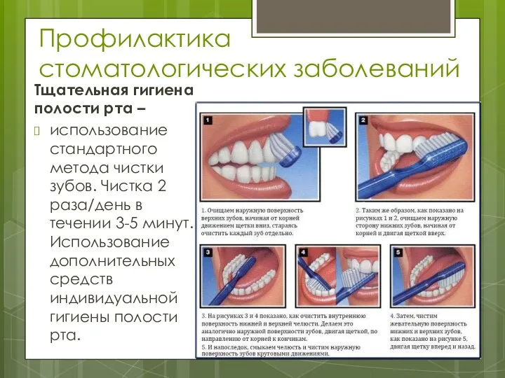 Профилактика стоматологических заболеваний Тщательная гигиена полости рта – использование стандартного метода чистки зубов.