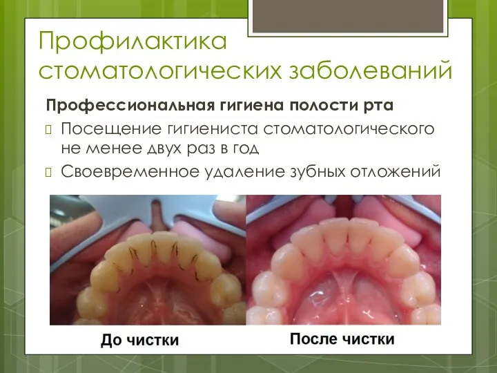 Профилактика стоматологических заболеваний Профессиональная гигиена полости рта Посещение гигиениста стоматологического