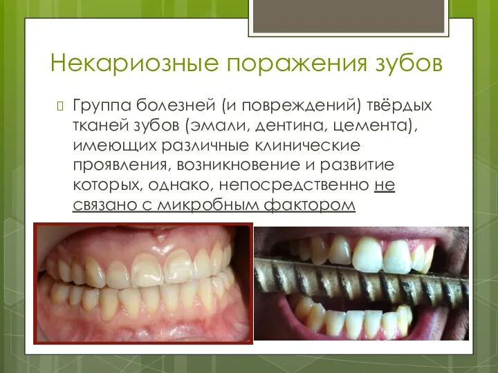Некариозные поражения зубов Группа болезней (и повреждений) твёрдых тканей зубов