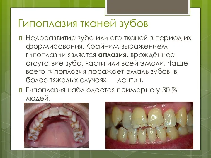 Гипоплазия тканей зубов Недоразвитие зуба или его тканей в период их формирования. Крайним