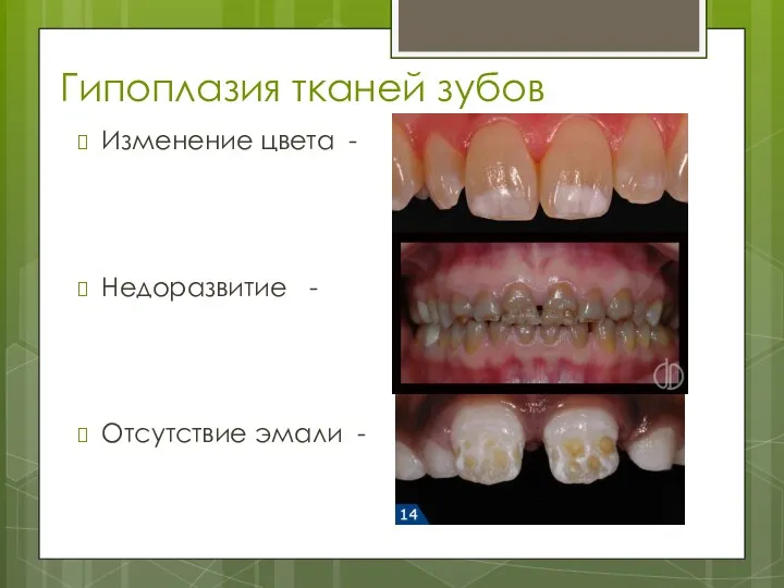 Гипоплазия тканей зубов Изменение цвета - Недоразвитие - Отсутствие эмали -