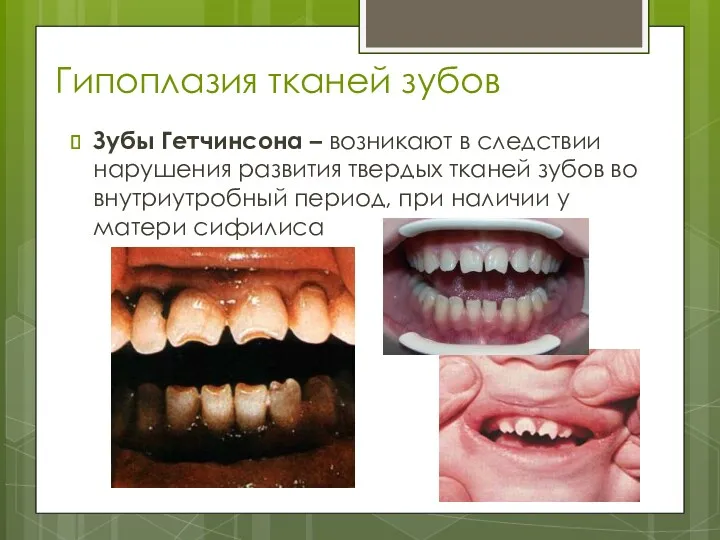 Гипоплазия тканей зубов Зубы Гетчинсона – возникают в следствии нарушения