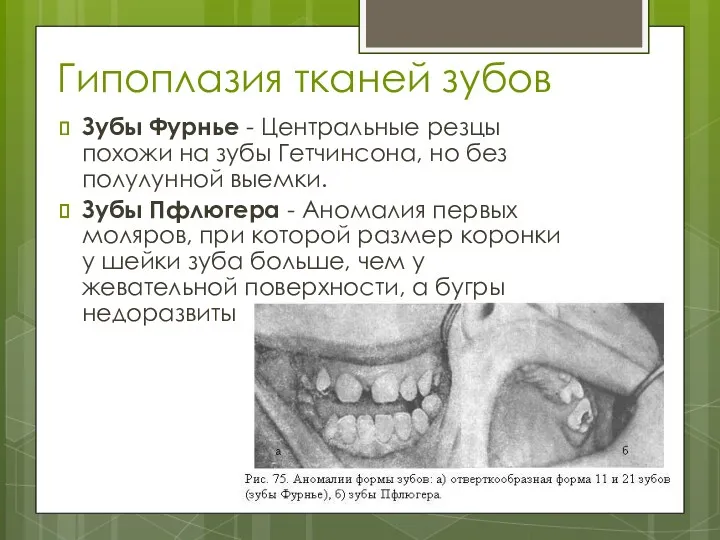 Гипоплазия тканей зубов Зубы Фурнье - Центральные резцы похожи на зубы Гетчинсона, но