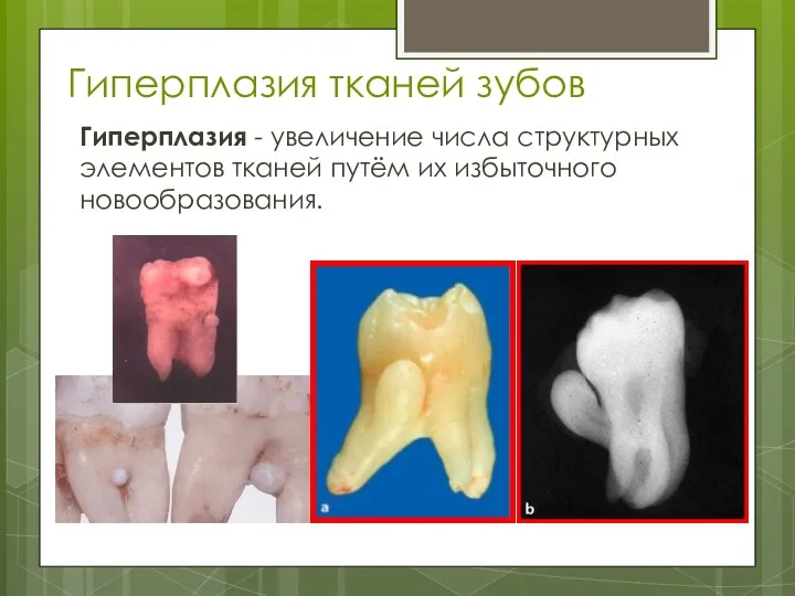 Гиперплазия тканей зубов Гиперплазия - увеличение числа структурных элементов тканей путём их избыточного новообразования.