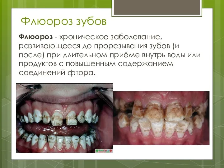 Флюороз зубов Флюороз - хроническое заболевание, развивающееся до прорезывания зубов (и после) при