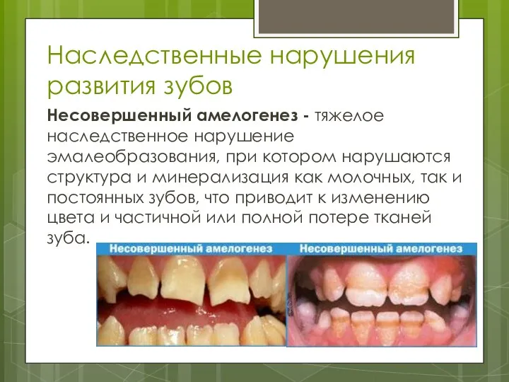 Наследственные нарушения развития зубов Несовершенный амелогенез - тяжелое наследственное нарушение эмалеобразования, при котором