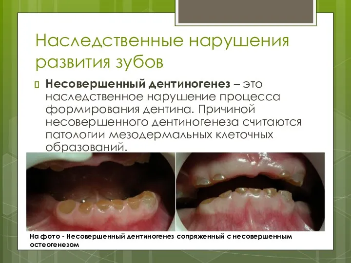 Наследственные нарушения развития зубов Несовершенный дентиногенез – это наследственное нарушение
