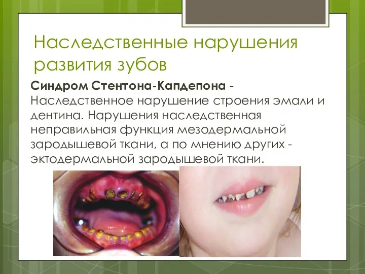 Наследственные нарушения развития зубов Синдром Стентона-Капдепона - Наследственное нарушение строения эмали и дентина.