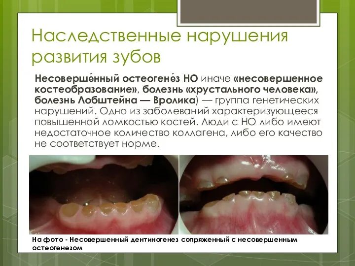 Наследственные нарушения развития зубов Несоверше́нный остеогене́з НО иначе «несовершенное костеобразование», болезнь «хрустального человека»,