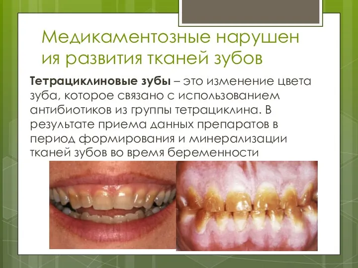 Медикаментозные нарушения развития тканей зубов Тетрациклиновые зубы – это изменение цвета зуба, которое
