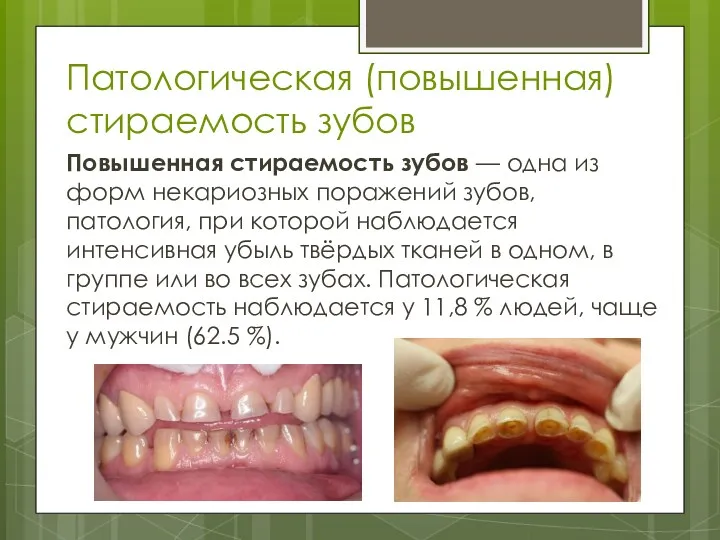 Патологическая (повышенная) стираемость зубов Повышенная стираемость зубов — одна из форм некариозных поражений