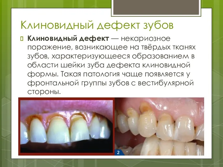 Клиновидный дефект зубов Клиновидный дефект — некариозное поражение, возникающее на твёрдых тканях зубов,