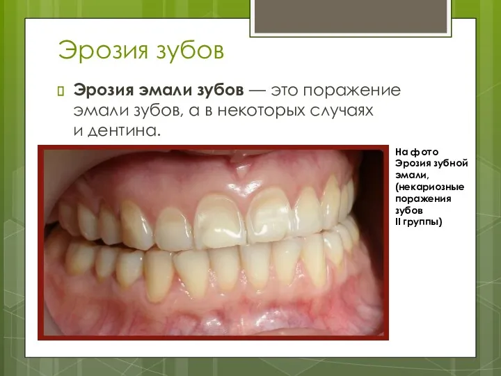 Эрозия зубов Эрозия эмали зубов — это поражение эмали зубов, а в некоторых
