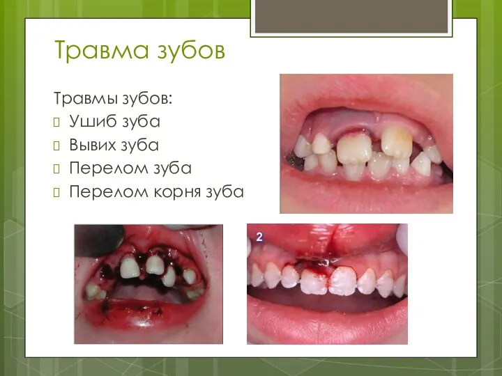 Травма зубов Травмы зубов: Ушиб зуба Вывих зуба Перелом зуба Перелом корня зуба