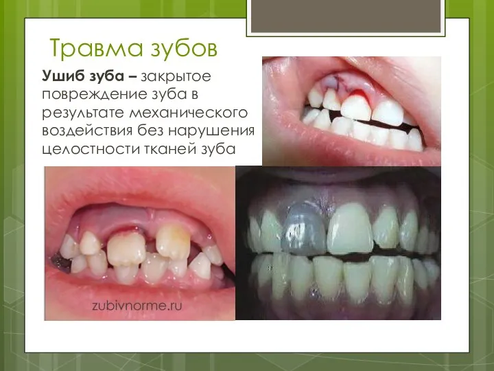 Травма зубов Ушиб зуба – закрытое повреждение зуба в результате