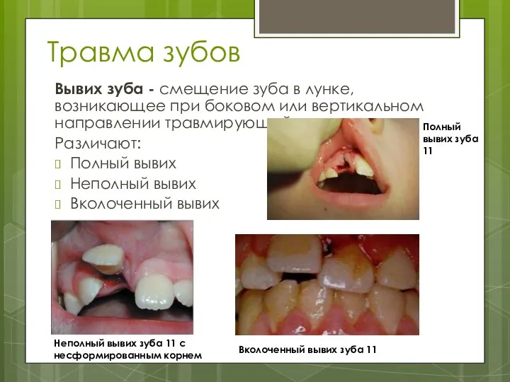 Травма зубов Вывих зуба - смещение зуба в лунке, возникающее при боковом или