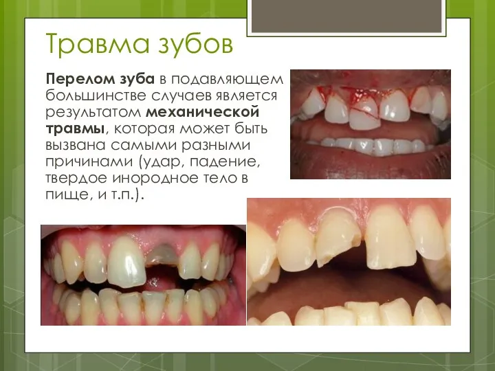 Травма зубов Перелом зуба в подавляющем большинстве случаев является результатом