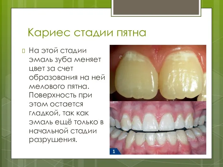 Кариес стадии пятна На этой стадии эмаль зуба меняет цвет за счет образования