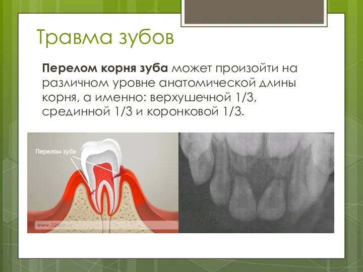 Травма зубов Перелом корня зуба может произойти на различном уровне анатомической длины корня,