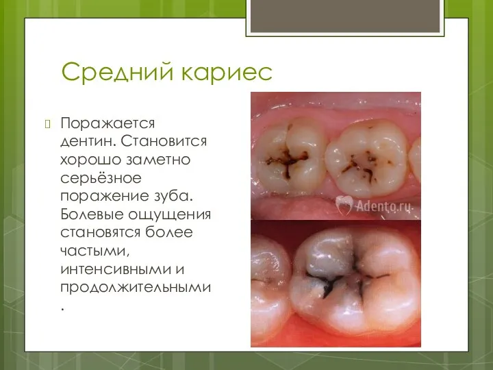 Средний кариес Поражается дентин. Становится хорошо заметно серьёзное поражение зуба.