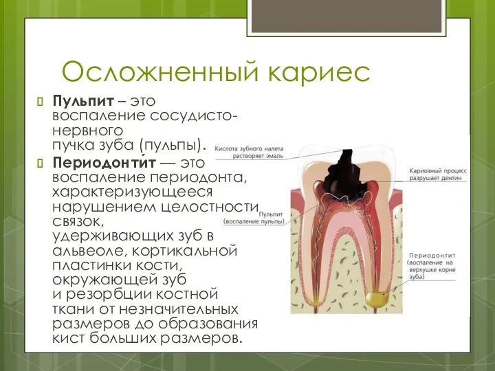 Осложненный кариес Пульпит – это воспаление сосудисто-нервного пучка зуба (пульпы). Периодонти́т — это