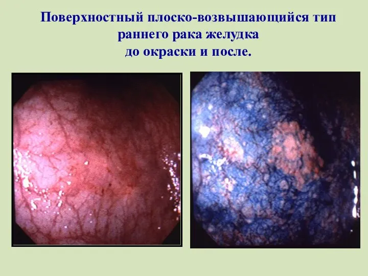 Поверхностный плоско-возвышающийся тип раннего рака желудка до окраски и после.