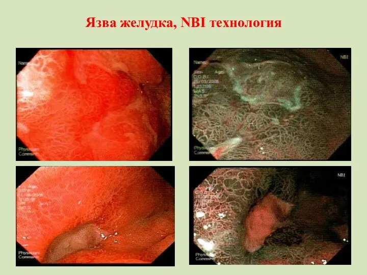 Язва желудка, NBI технология