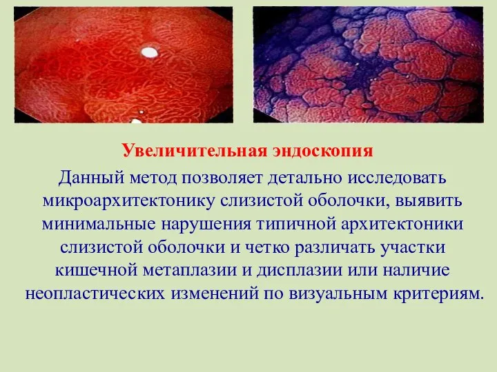 Увеличительная эндоскопия Данный метод позволяет детально исследовать микроархитектонику слизистой оболочки,