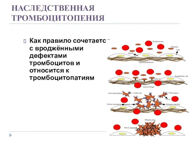 НАСЛЕДСТВЕННАЯ ТРОМБОЦИТОПЕНИЯ Как правило сочетается с вроджёнными дефектами тромбоцитов и относится к тромбоцитопатиям