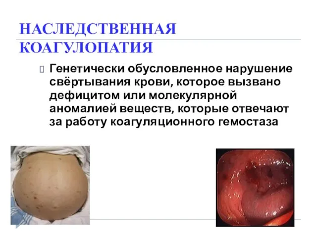 НАСЛЕДСТВЕННАЯ КОАГУЛОПАТИЯ Генетически обусловленное нарушение свёртывания крови, которое вызвано дефицитом